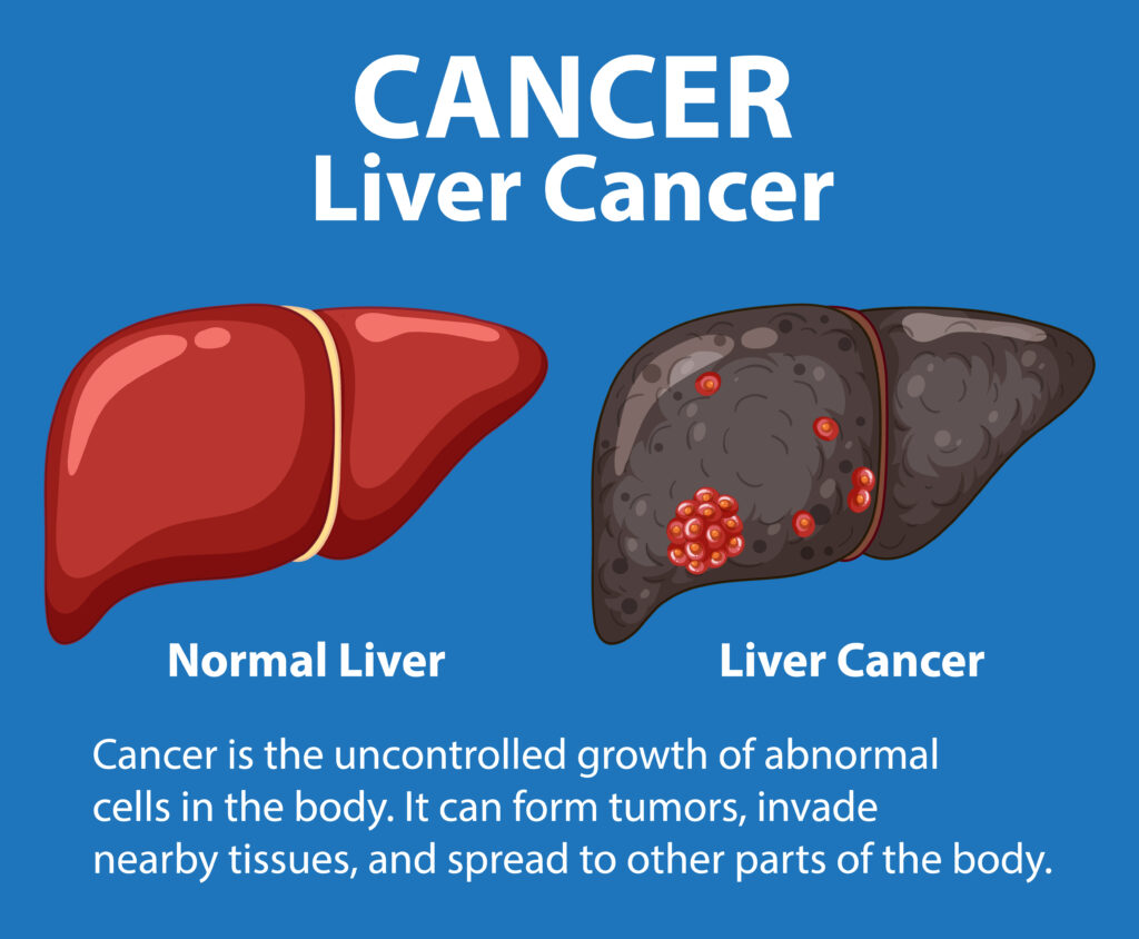 Liver cancer