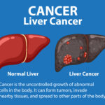 Liver cancer